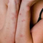 How to tell the difference between flea bites and bed bug bites.