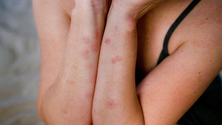 How to tell the difference between flea bites and bed bug bites.